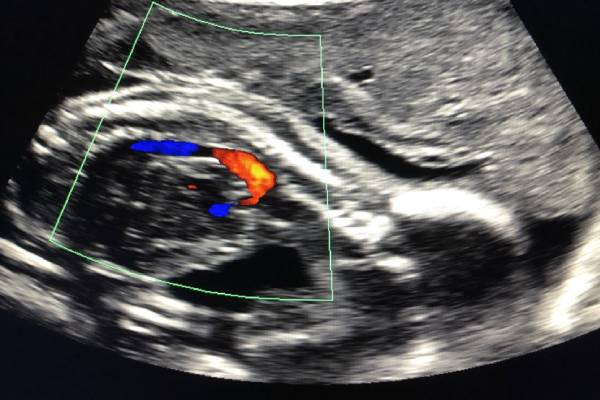 Fetal Echocardiography Scan in Pune