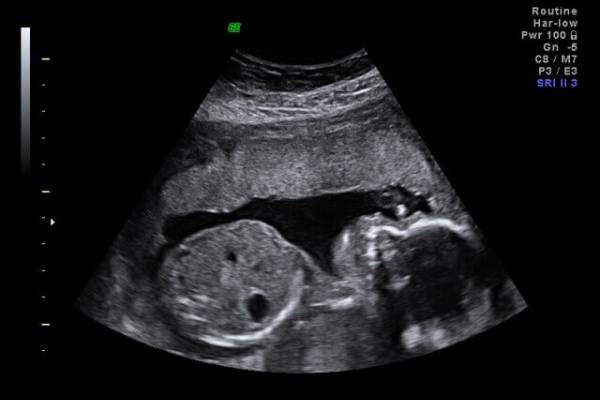 fetal malformation scan in pune , testing baby before born