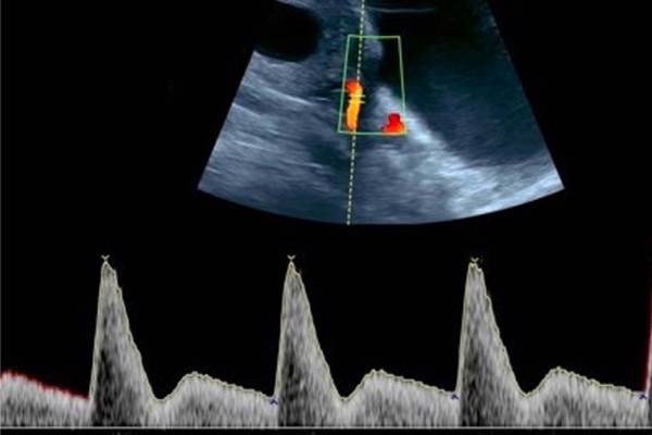 In Image Testing, Pre-Eclampsia Screening in Pune